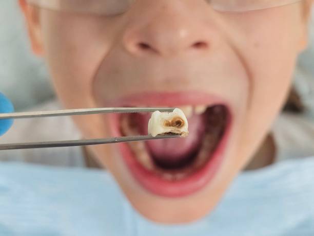 Best Emergency Dental Care for Sports Injuries in Mountain View, NC